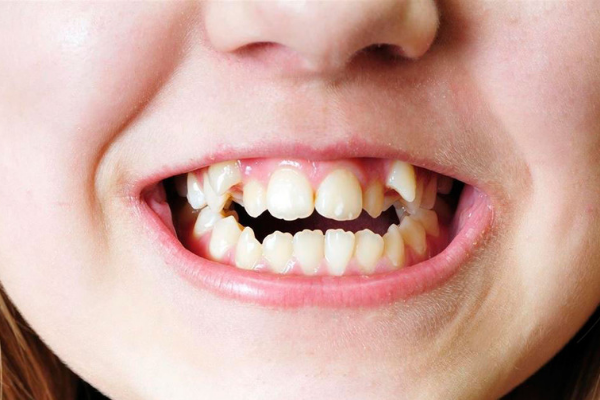 consecuencias maloclusión dental