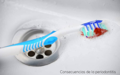 Consecuencias de la periodontitis para la salud