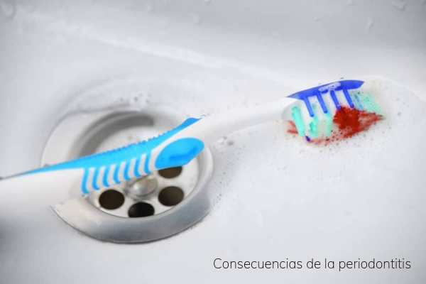 Consecuencias de la periodontitis para la salud