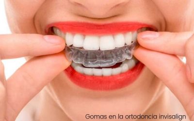 El uso de gomas en la ortodoncia invisalign