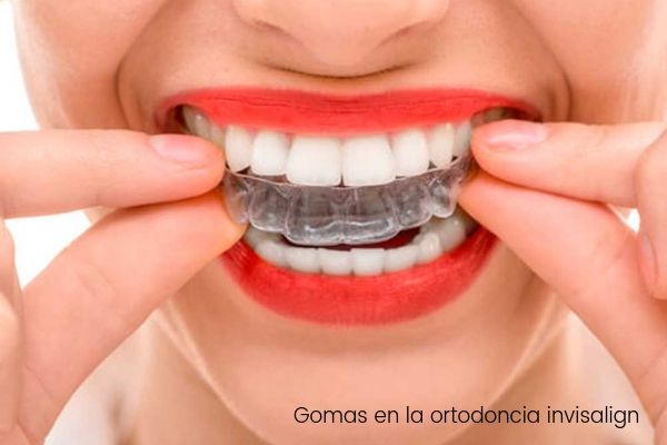 El uso de gomas en la ortodoncia invisalign